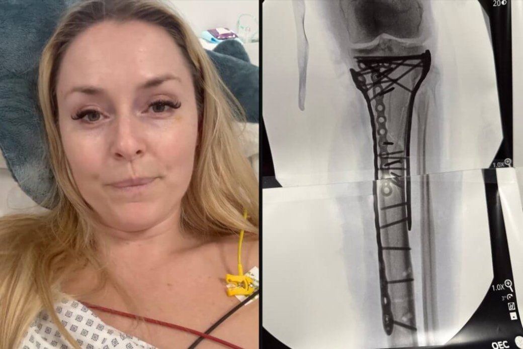 Lindsey Vonn’s ‘car crash’ injury explained: How long could her recovery take and will she ski again?