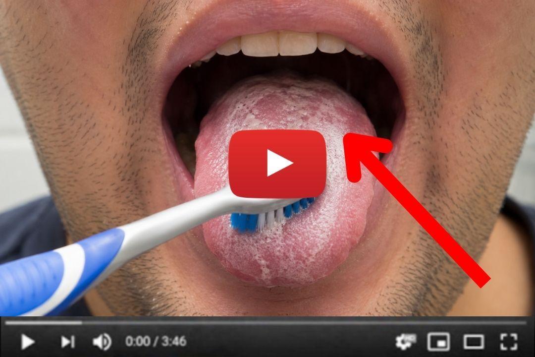 Man brushing white coating on his tongue