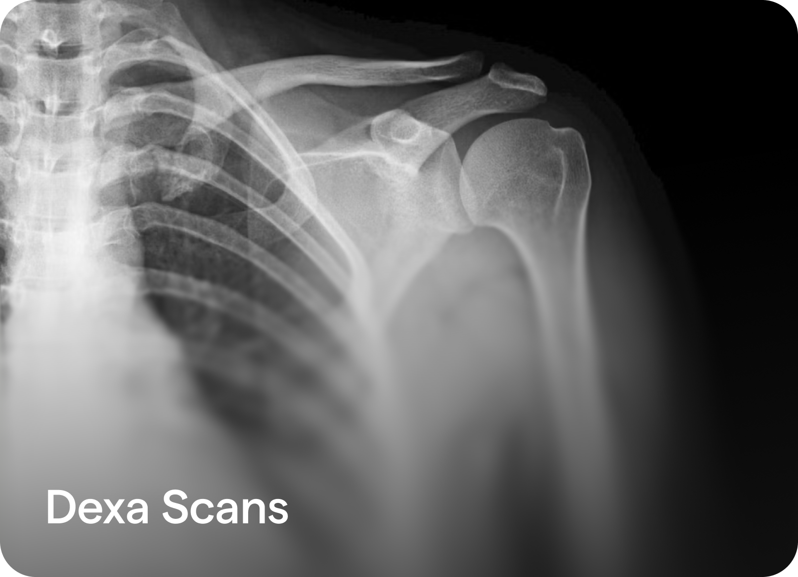 Dexa Scans